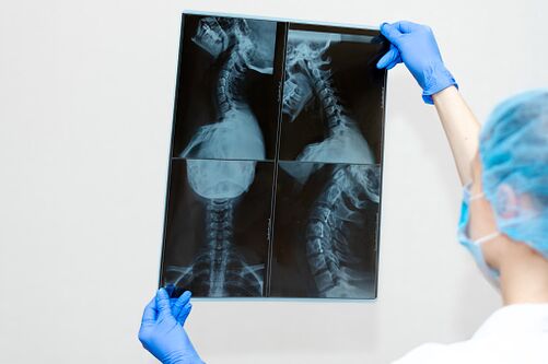 Osteochondrosis spinal cord