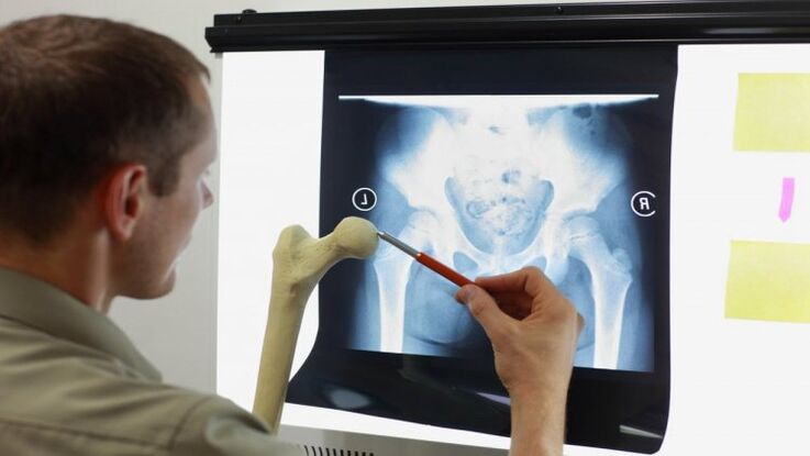 The doctor examines an X-ray for hip arthrosis