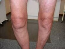Symptoms of arthrosis of the knee joint